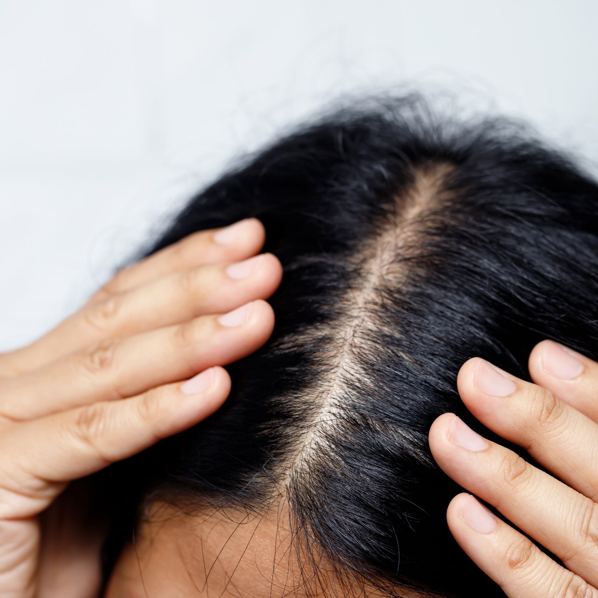 Scalp Therapy- Leave In Treatment For A Dry, Itchy & Dandruff Prone Scalp